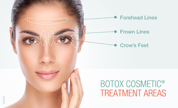 BOTOX Cosmetic Treatment Areas